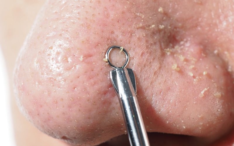 Chỉ nên tự nặn khi nhân mụn đã trồi lên gần bề mặt