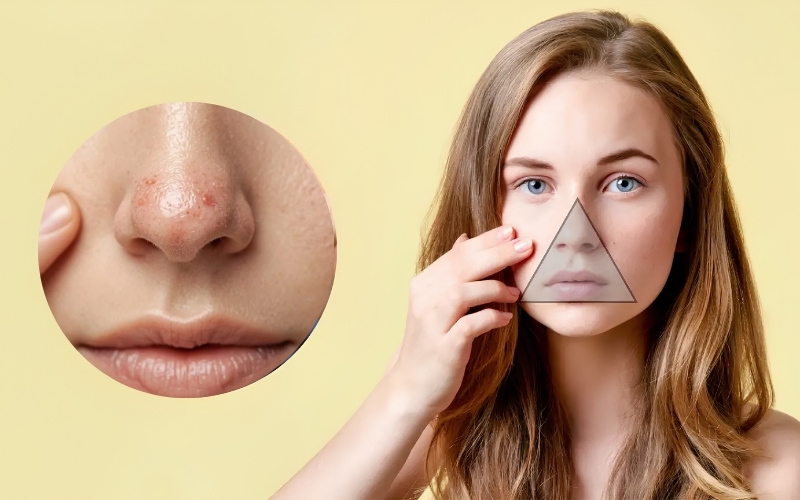 Không nên tự nặn mụn khu vực vùng tam giác