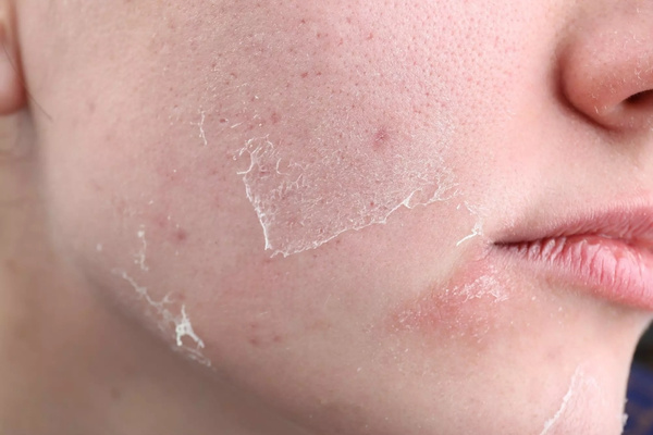 Bắn laser tại cơ sở kém uy tín có thể gây sưng đỏ, tăng sắc tố nặng hơn