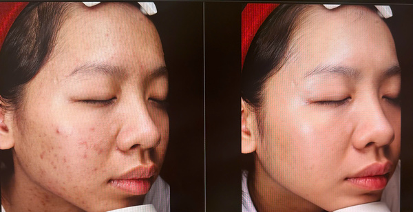 Công nghệ Laser Fractional CO2 hỗ trợ trị thâm mụn tận gốc, cải thiện sẹo rỗ và tái tạo da