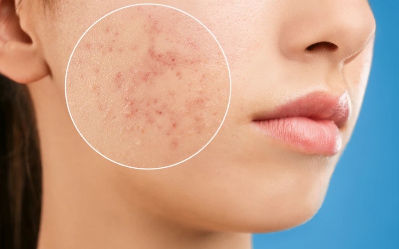 Giải đáp thắc mắc lấy nhân mụn có hết mụn không