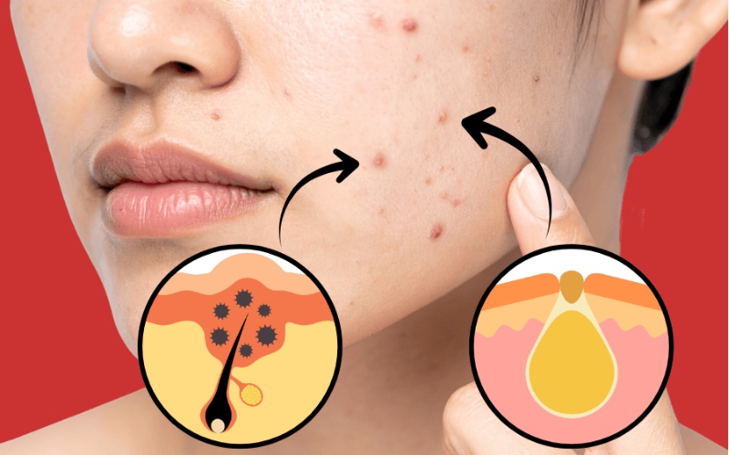 Giải đáp thắc mắc lấy nhân mụn có hết mụn không