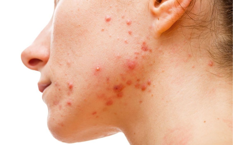 Không lấy nhân đối với các loại mụn viêm