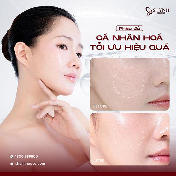 Quy trình chăm sóc da chuyên sâu trong liệu trình trị sẹo rỗ tại Shynh House