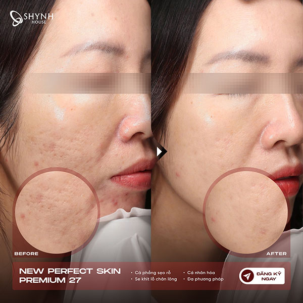 Điều trị sẹo rỗ bằng công nghệ laser giúp cải thiện bề mặt da và kích thích tái tạo collagen