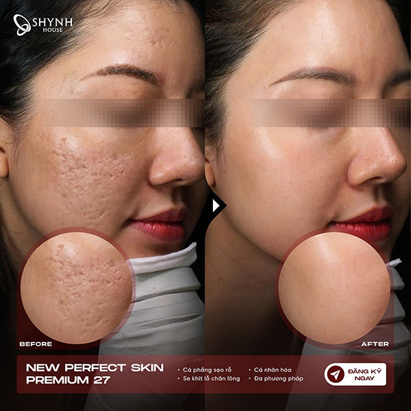 So sánh làn da trước và sau khi thực hiện liệu trình trị sẹo rỗ, bề mặt da mịn và đều màu hơn