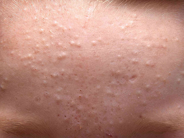 Cận cảnh những nốt mụn ẩn li ti trên bề mặt da