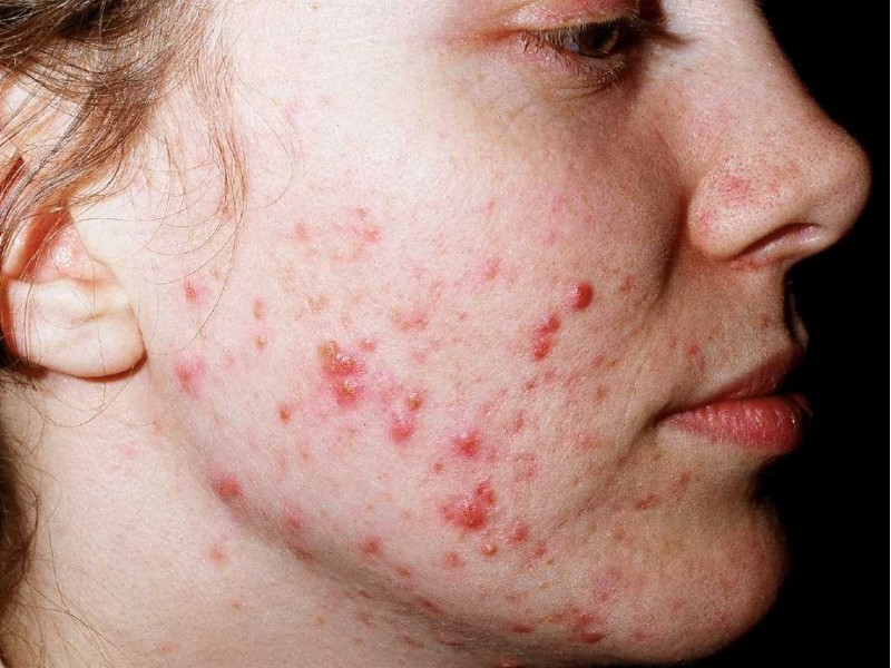 Mụn mủ viêm sưng đỏ đầu trắng trên má không nên tự nặn tại nhà