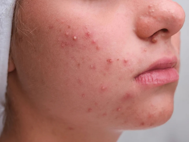 Không nên tự nặn như mụn bọc, mụn nang và mụn vùng tam giác nguy hiểm
