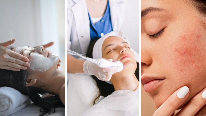 Nặn mụn đúng thời điểm, chỉ lấy nhân khi mụn đã chín hoàn toàn