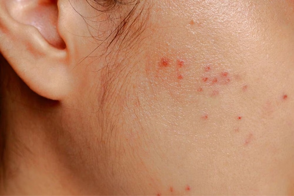 Loại da và tình trạng mụn quyết định lớn đến thời gian đẩy mụn sau peel