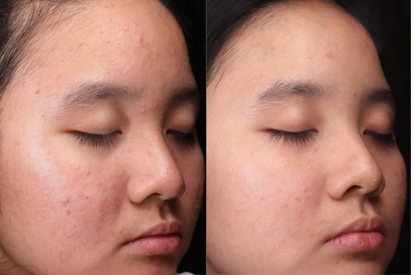 Peel da trị mụn giúp gom cồi, làm mờ thâm, thu nhỏ lỗ chân lông và hạn chế mụn tái phát