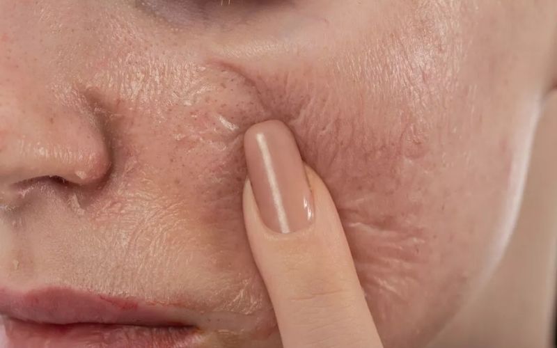 Hiện tượng da nhạy cảm tạm thời trong giai đoạn phục hồi sau peel
