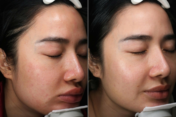 Peel da tại Shynh House với công nghệ độc quyền, giúp lấy lại làn da rạng rỡ, đều màu