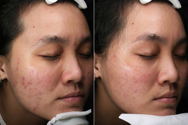 Thâm mụn được cải thiện rõ rệt sau liệu trình peel da tái sinh tại Shynh House