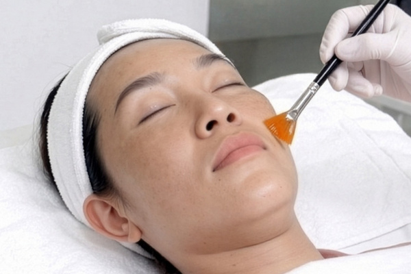Mỗi cấp độ peel da tác động vào tầng da khác nhau, xử lý mụn và các vấn đề da đi kèm