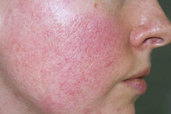 Peel trị mụn không đúng cách có thể gây nhiễm trùng, bỏng da