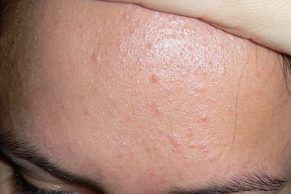 Peel nông phù hợp xử lý mụn đầu đen, mụn ẩn, ít gây kích ứng