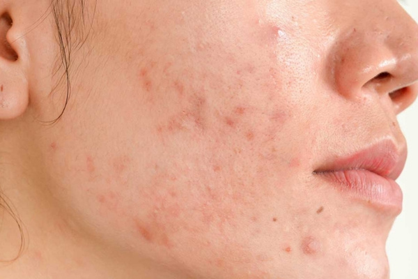 Da bị thâm đỏ, mụn viêm mức độ nhẹ phù hợp để peel da trung bình