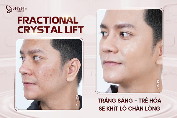 Làn da sau điều trị trở nên săn chắc hơn, lỗ chân lông thu nhỏ dần và bề mặt da mịn màng