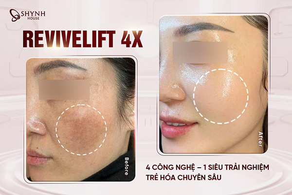 Liệu trình Revivelift 4X giúp tái cấu trúc và làm mịn bề mặt da