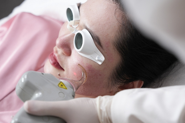 Điều trị bằng laser giúp kích thích tăng sinh collagen, làm đầy vết lõm