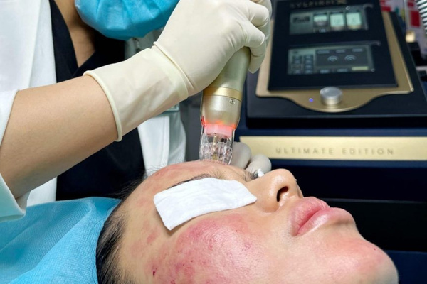 Vi kim RF kích thích cơ thể tự chữa lành, tăng sinh collagen mạnh mẽ