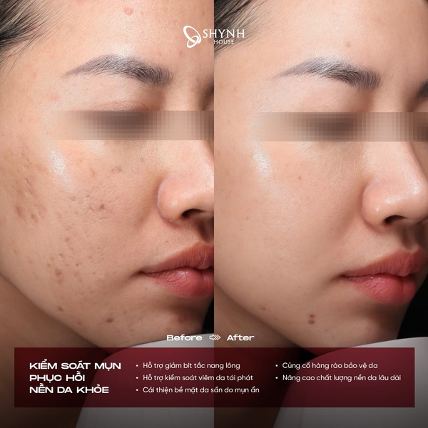 Shynh House áp dụng đa dạng phương pháp trị mụn, giúp cải thiện thâm sẹo
