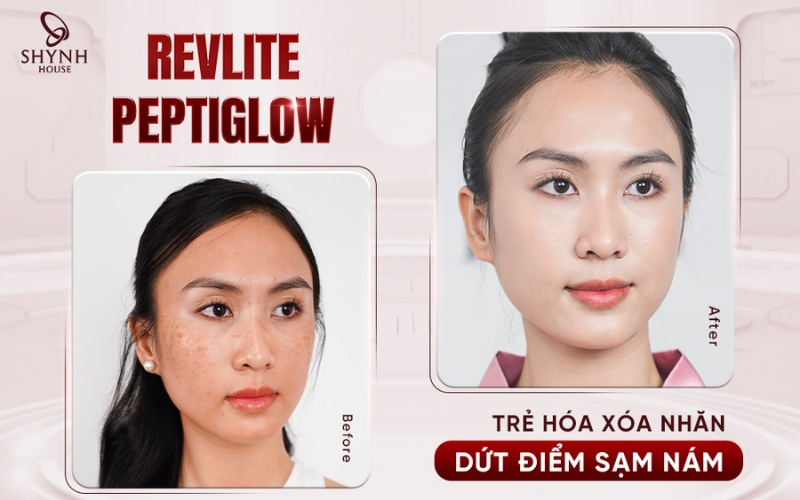Khả năng tái tạo da và cơ địa ảnh hưởng đến tốc độ mờ thâm sau laser