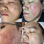 Sẹo rỗ lâu năm có trị được không? Hiệu quả tùy vào phương pháp can thiệp y khoa