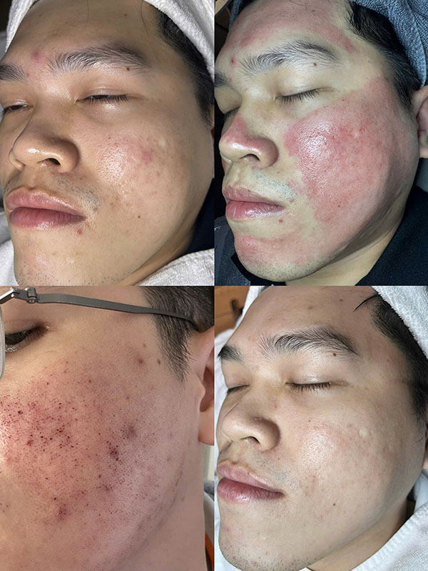 Sẹo rỗ lâu năm có trị được không? Hiệu quả tùy vào phương pháp can thiệp y khoa
