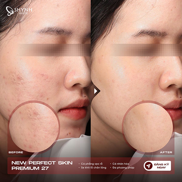 Da bị tổn thương do mụn viêm lâu năm dẫn đến việc sẹo rỗ khó cải thiện
