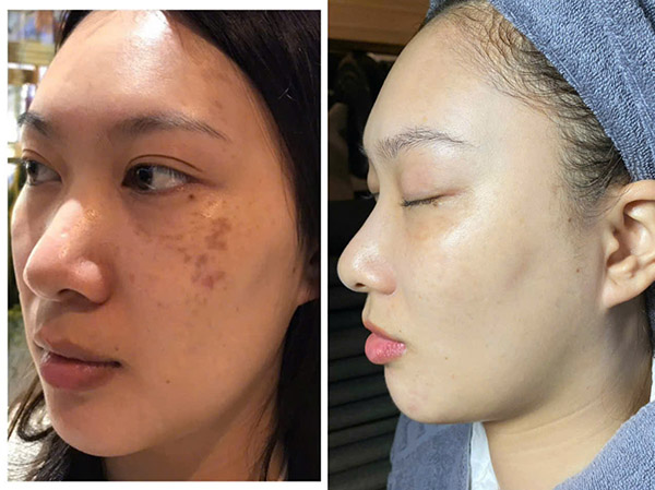 Làn da có thể bị nám do tia UV, nội tiết và lão hóa gây tăng sắc tố melanin trên bề mặt da