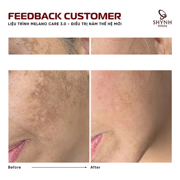 Kỹ thuật tiêm mesotherapy đưa dưỡng chất vào lớp trung bì giúp ức chế melanin và cải thiện sắc tố da