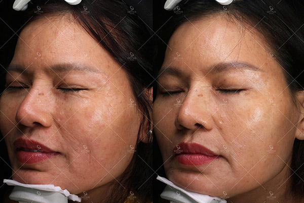 Công nghệ Laser Toning tác động nhẹ nhàng lên sắc tố giúp làm sáng da và cải thiện tình trạng nám sạm