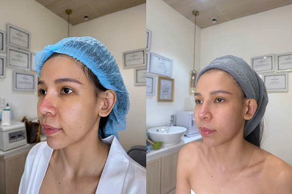 Khách hàng được bác sĩ thăm khám và thực hiện liệu trình trị nám chuẩn y khoa tại Shynh House