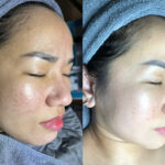 Tìm hiểu các tiêu chí lựa chọn spa trị nám uy tín trước khi quyết định điều trị nám da