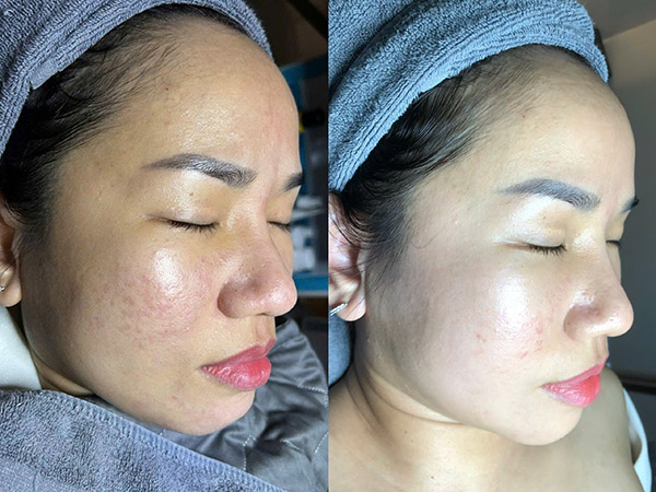 Tìm hiểu các tiêu chí lựa chọn spa trị nám uy tín trước khi quyết định điều trị nám da