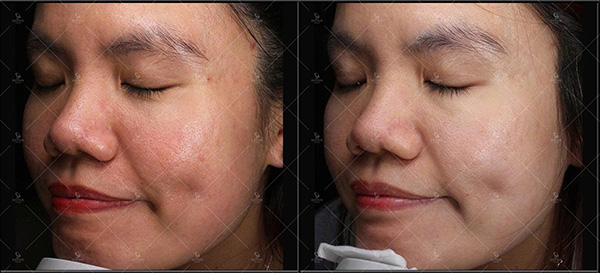 Quy trình điều trị nám da chuẩn y khoa gồm soi da, thăm khám và thực hiện liệu trình theo phác đồ