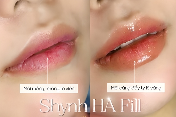 Hiệu quả tiêm filler môi có thể kéo dài khác nhau ở mỗi người