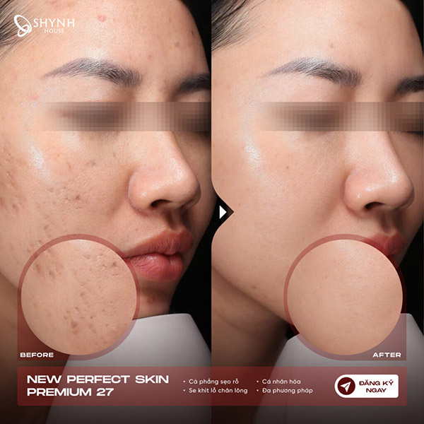 Tư vấn phác đồ New Perfect Skin cá nhân hóa tại Shynh House