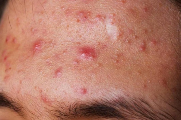 Mụn viêm tái phát, thâm sẹo hoặc da kích ứng là những dấu hiệu nên thăm khám trị mụn