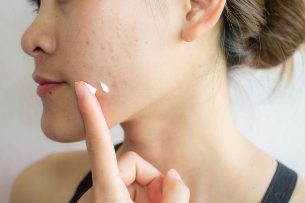 Chăm sóc da đúng cách sau trị mụn chuẩn y khoa để không để lại thâm, sẹo