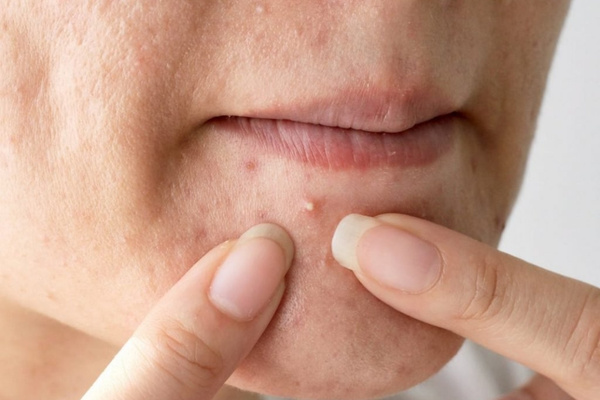 Mỗi loại mụn cần phương pháp và công nghệ điều trị riêng, dẫn đến chênh lệch về chi phí