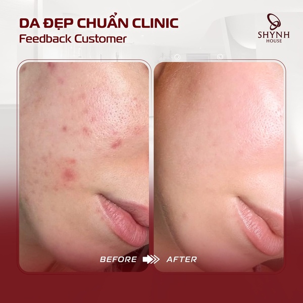 Lựa chọn địa chỉ spa điều trị mụn uy tín giúp đảm bảo hiệu quả và an toàn