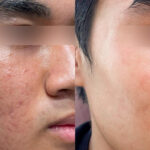 Trị sẹo rỗ giúp da phục hồi cấu trúc collagen, cải thiện rõ rệt các vết lõm trên bề mặt da