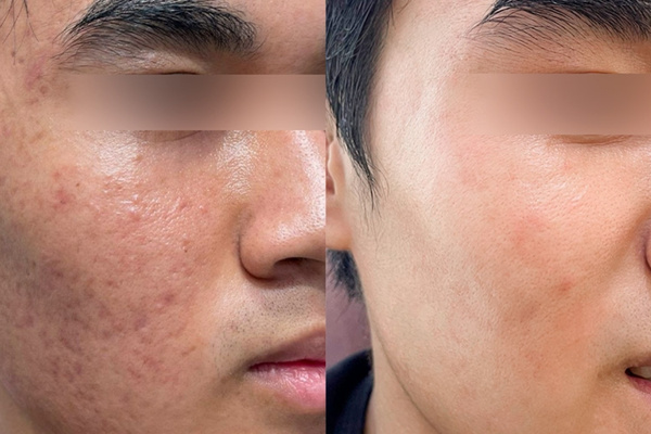 Trị sẹo rỗ giúp da phục hồi cấu trúc collagen, cải thiện rõ rệt các vết lõm trên bề mặt da
