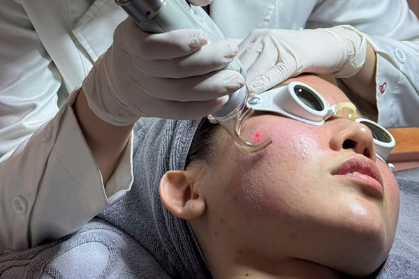 Laser fractional tạo vi tổn thương nhiệt có kiểm soát, kích thích tái tạo collagen