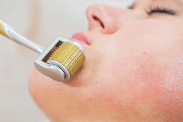 Trị sẹo rỗ bằng lăn kim an toàn với nhiều loại da kể cả da sẫm màu