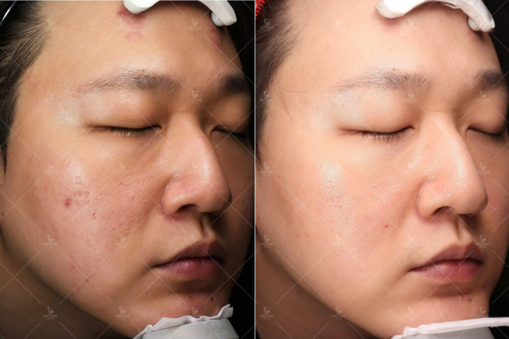 Làn da xuất hiện sẹo rỗ khiến bề mặt kém mịn, ảnh hưởng thẩm mỹ